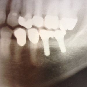 Zahnersatz auf Implantaten